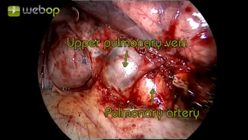 Preparation of the superior pulmonary vein