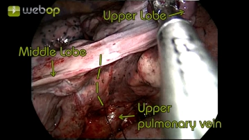 Dissection of the minor fissure (between the upper and middle lobes)