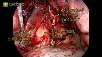 Dissection of the upper pulmonary vein