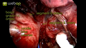 Darstellung der Pars interlobaris der Pulmonalarterie