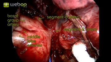 Visualization of the pars interlobaris of the pulmonary artery