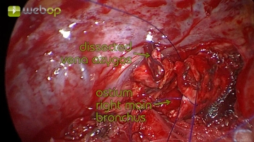 Suture of the bronchial stump