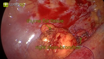 Coverage of the bronchial stump