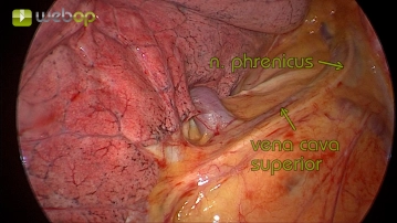 Preparation and dissection of the azygos vein