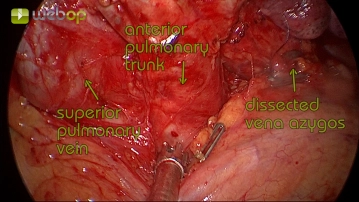 Preparation of the lung hilum and the pulmonary artery
