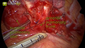 Dissection of the anterior trunk of the pulmonary artery