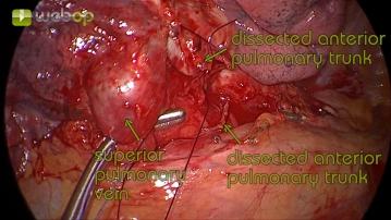 Preparation of the upper pulmonary vein
