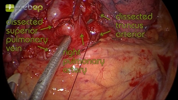 Resection of the central pulmonary artery