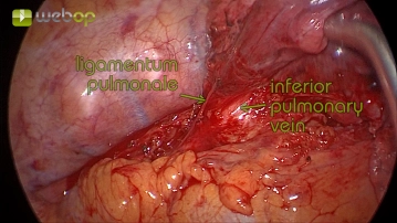 Preparation of the pulmonary ligament and the inferior pulmonary vein