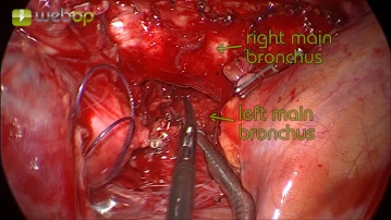 Preparation of the right main bronchus
