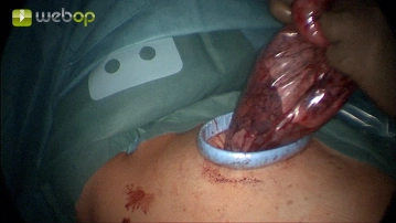 Retrieval of the specimen