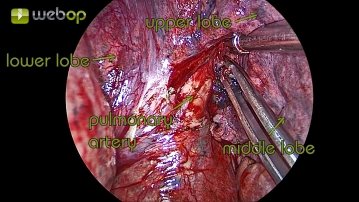 Präparation der Pulmonalarterie