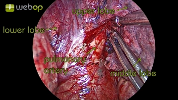 Preparation of the pulmonary artery