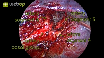Preparation of the lobar fissure