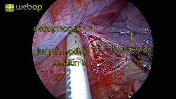Preparation of the mediastinal pleura