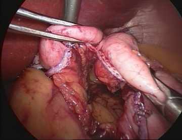 Fashioning the gastric pouch