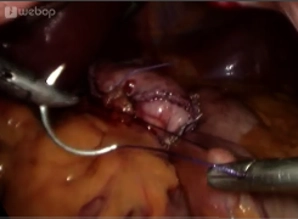 Parallel anchoring of the limb on the gastric pouch
