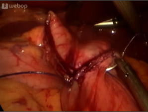 Fashioning the gastroenterostomy (suture closure of the anterior wall)