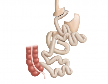 Fashioning the enteroenterostomy II