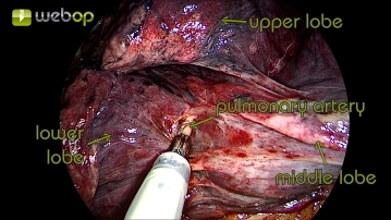 Preparation of the lobar fissure with visualization of the pulmonary artery