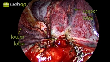 Preparation of the interlobium between the upper, middle, and lower lobes