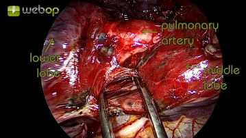 Dissection of the parenchymal bridges between the lower and middle lobes