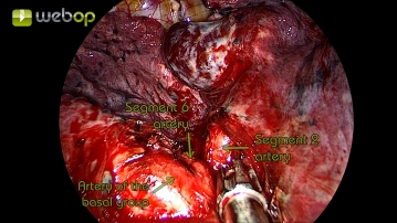 Präparation und Resektion der Segmentarterie A2