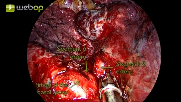 Preparation and resection of the segmental artery A2