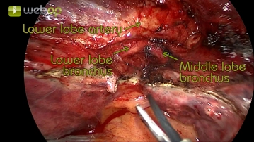 Exploración del tórax y preparación de la arteria pulmonar en la fisura lobar