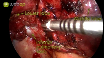 Preparación del ligamento pulmonar y visualización de la vena pulmonar inferior