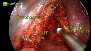Resección en bloque de los ganglios linfáticos de la estación 7 (según IALSC)