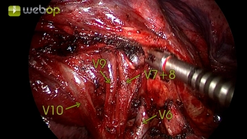 Preparación de la vena pulmonar inferior