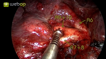 Preparación de la pars basalis de la arteria pulmonar