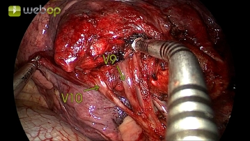 División de las venas segmentarias V10 y V9
