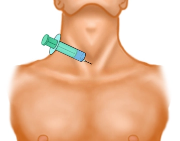 Local anesthesia of the surgical field