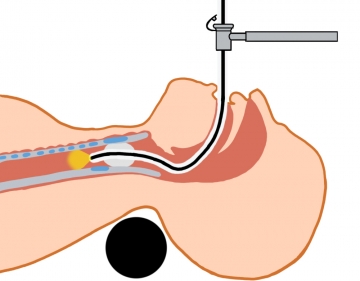 Bronchoscopic overview