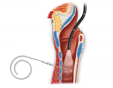 Tracheal puncture and introduction of the Seldinger guidewire