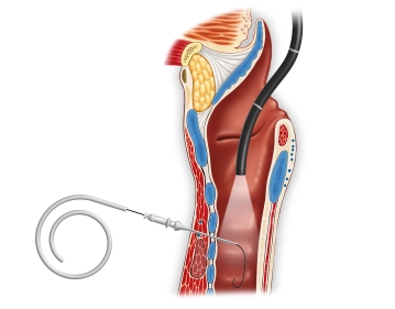 Tracheal puncture and introduction of the Seldinger guidewire