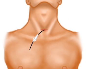 Skin incision and insertion of the dilator