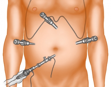 Trocar positioning