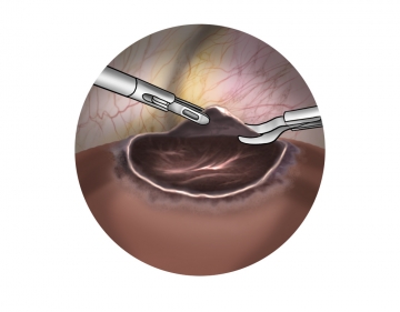 Inspecting the cyst for neoplasia