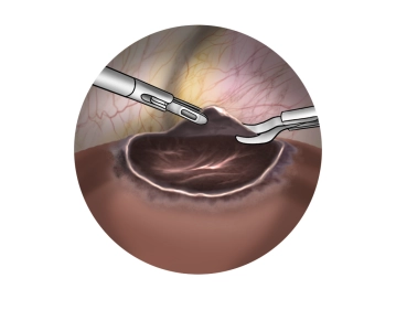 Inspecting the cyst for neoplasia