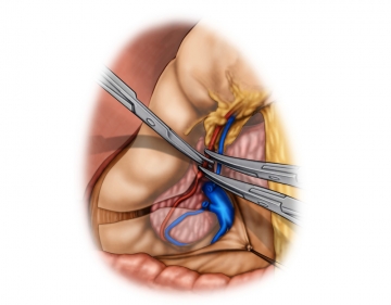 Dividing the greater omentum and gastroepiploic vessels