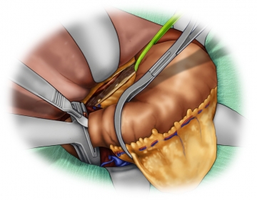 Transecting the duodenum