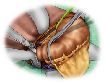 Transecting the duodenum
