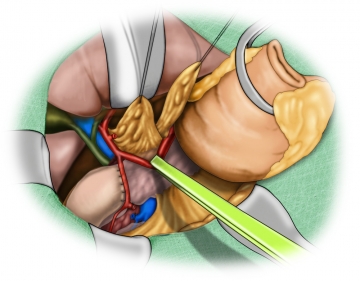 Lymphadenectomy along the hepatic artery
