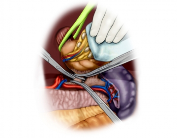 Lymphadenectomy along the splenic artery