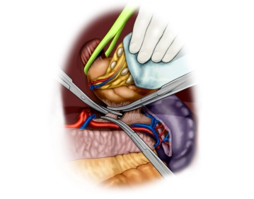 Lymphadenectomy along the splenic artery