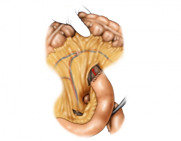 Constructing the Roux limb