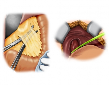 Dividing the lesser omentum, dissecting the gastroesophageal junction